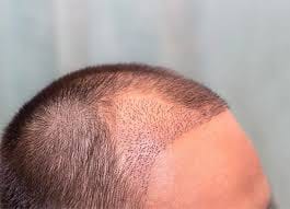 Insider Secrets to Haartransplantation Türkei Kosten and Hair Renewal